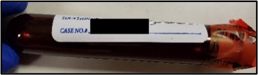 This patient sticker was placed over the lot number and expiration date. This specimen is acceptable for testing; however, a note is added to the case record that the expiration date was not visible to the scientist.