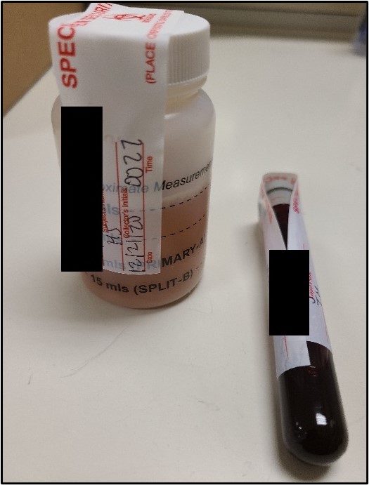 DFSA Kit specimens showing proper labeling and label placement. Please include the date, time, subject’s name, and case/identification number. Additional information may be added. Just as for blood tubes submitted for DUI/DUID testing, if the expiration date is covered a note is added to the case record that it was not visible to the scientist.